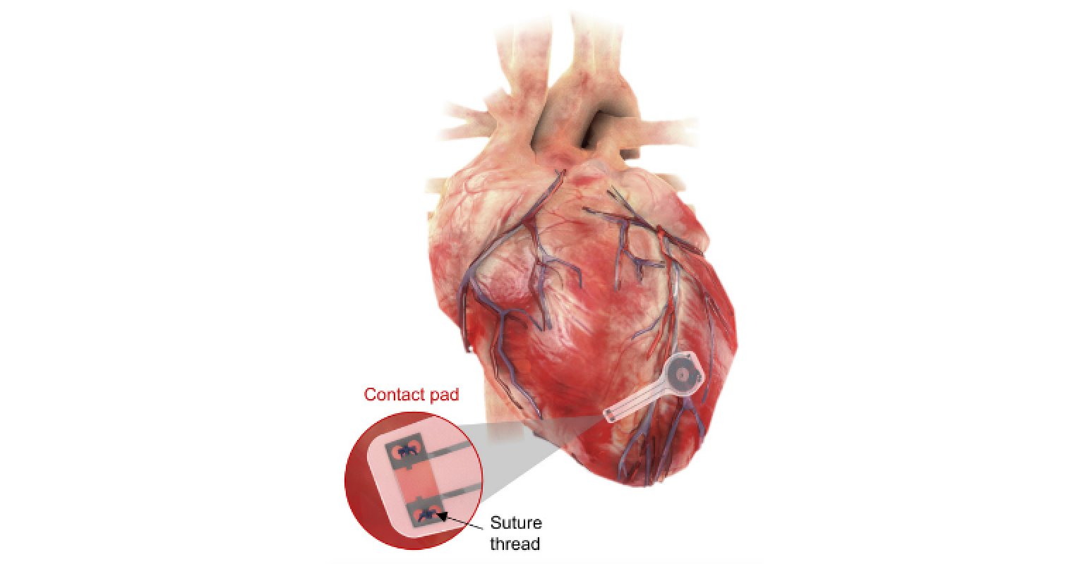stimulateur cardiaque biorésorbable