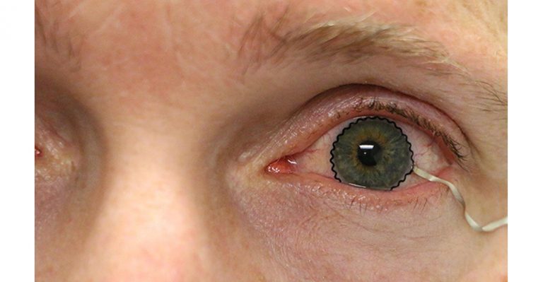 La technologie des lentilles de contact permet la surveillance des conditions médicales