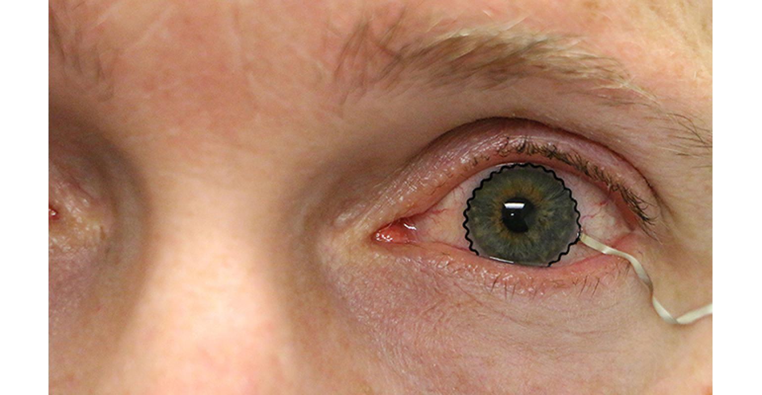 lentille de contact avec biocapteur