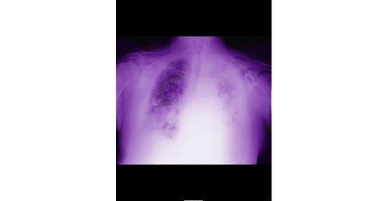 Radiographie du poumon avec intelligence artificielle mésothéliome