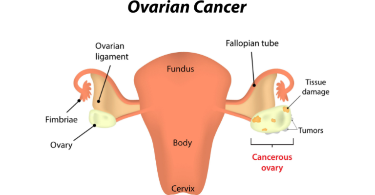 Cet appareil Itty Bitty pourrait détecter le cancer de l’ovaire plus tôt