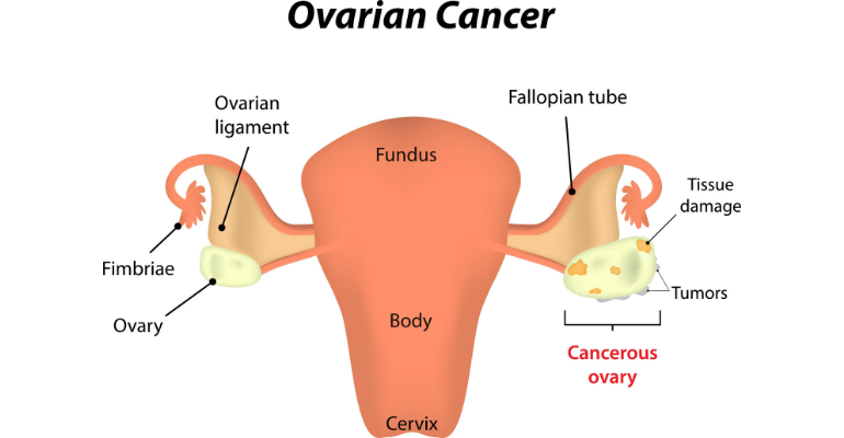 schéma du cancer de l'ovaire